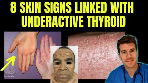 Skin sores that appear suddenly and heal slowly. . Skin crawling sensation thyroid